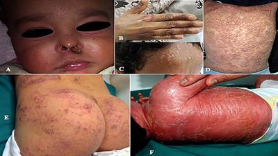 A Prospective Survey of Skin Manifestations in Children With Inborn Errors of Immunity From a National Registry Over 17 Years